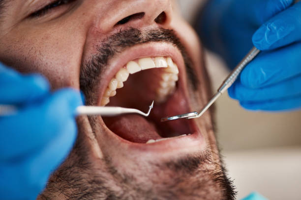 Best Emergency Wisdom Teeth Removal in Grandview, OK